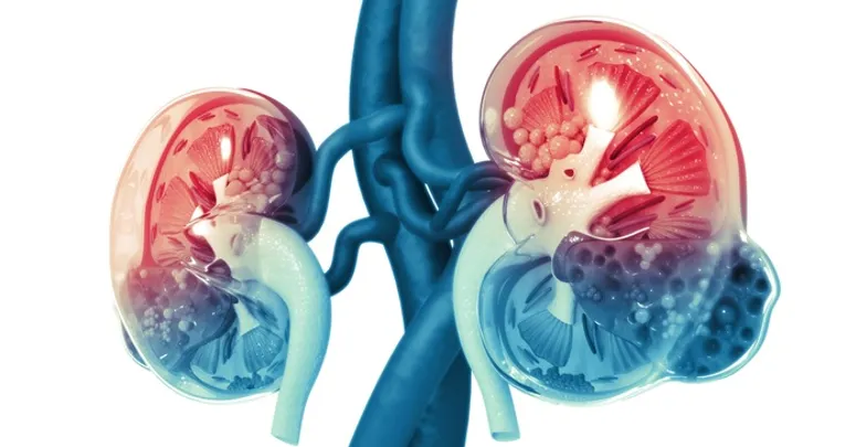 Gangguan Ginjal Akut (Acute Kidney Injury)